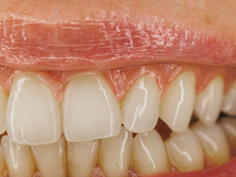 close-up-of-a-teeth-smiling-mouth-of-a-woman